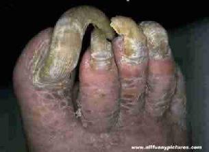 Cal lost his toenail clippers